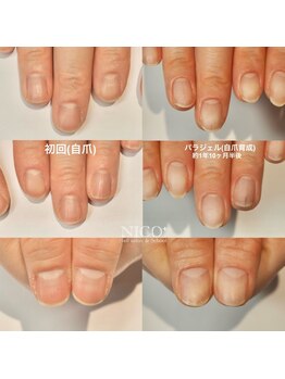 ニコプラス(NICO+)/自爪育成中