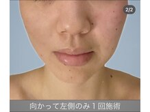 エラフリー/フェイスラインと赤みの改善(左)