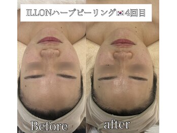 ラ ミュエル(La miel)/結果重視！韓国ILLONハーブ