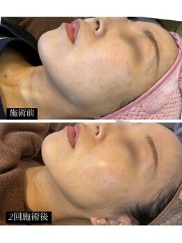 チャルム(CAL'ME)/レモンボトル・あごライン