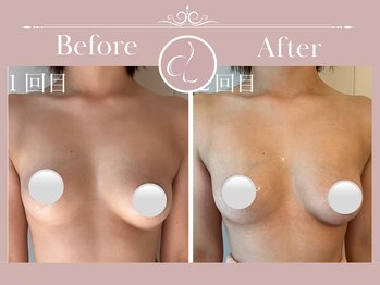 美バストアルファ(美bust α)/【バストアップ】症例