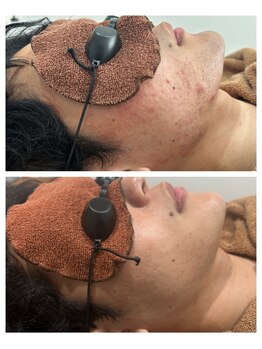 アカラ 読谷店(AKALA)/ヒゲ脱毛1年継続した結果!