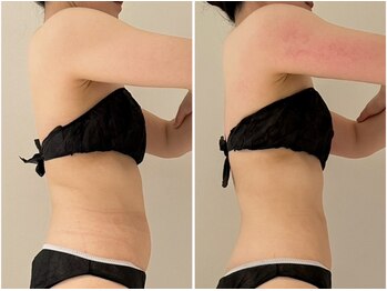 カレンジェビューティー(CarengeBeauty)/スリムカッター上半身コース