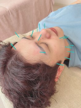 ヒーリングサロン アージュ(A-je)/★美顔鍼＋小顔矯正★