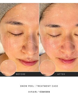 ノイ(noi.)/リジュランピール(snow peel)