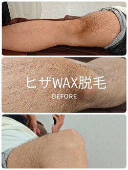 アルマサロン 菊陽(Almasalon)/両ひざ＋ふくらはぎWAX脱毛