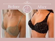 美バストアルファ(美bust α)/【バストアップ】症例