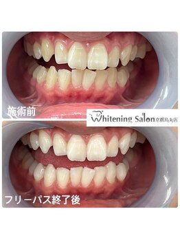 ホワイトニングサロン 京都烏丸店/ホワイトニング施術例