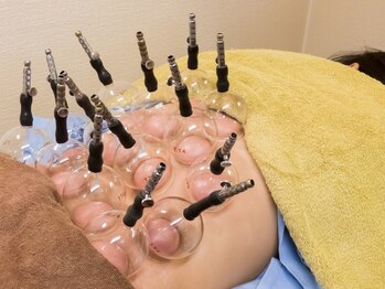 いなほ はりきゅう整骨院 東新宿/鍼灸(吸い玉併用)コース/東新宿