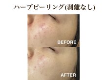 ティアム バイ テトテ 神戸三宮(TIAM by tetote)/ハーブピーリング