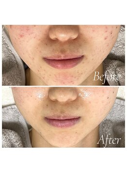 ミラリー(MIRALY)/頬ニキビケア 6ヶ月(20代後半)