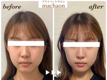 マカオン(machaon)/【小顔リフト】小顔マッサージ