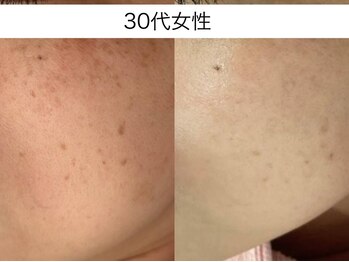 サクラ 本厚木駅前店(SAKURA)/50代 5回目写真【フェイシャル】