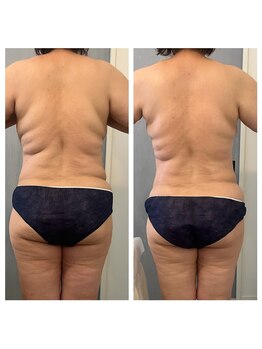 美温(mion)/本気痩身スタート