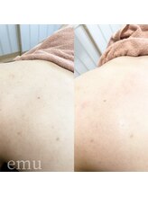 エミュ(emu)/背中wax＆光脱毛
