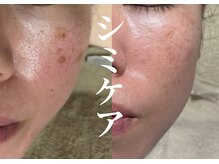Lume.Total Beauty Salon【11/2 OPEN（予定）】の雰囲気（専用の液でターンオーバー促進。頑固なシミもお任せください）