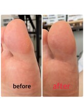 ホナ(HONA)/ガサガサかかとさよなら