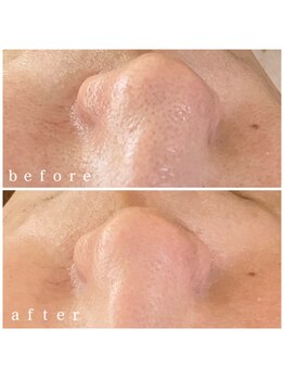 メナードフェイシャルサロン 岐阜茜部/毛穴ケア/くすみ/透明感/美白