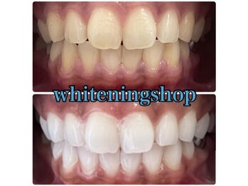 ホワイトニングショップ 天王寺店/10回ご来店後のお写真です