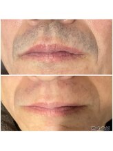 エステティック らぽーる(Rapport)/さらば、青髭！爆抜けひげ脱毛