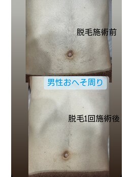 るあん/美肌脱毛