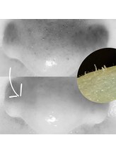 シエスタ 新小岩/小鼻の汚れ、毛穴の汚れ徹底ケア