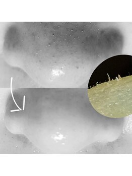 シエスタ 新小岩/小鼻の汚れ、毛穴の汚れ徹底ケア
