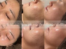 ティアラッシュ(TiaLash)の雰囲気（直後からお肌の変化を実感！エステ・アイラッシュ同日施術可◎）