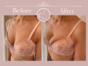 美バストアルファ(美bust α)/【バストアップ】症例