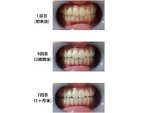 ネージュ(neige)の雰囲気（お客様のBefore→After写真☆通う頻度に比例して確実に白くなる）