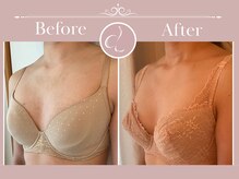 美バストアルファ(美bust α)/【バストアップ】症例