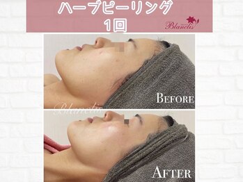 ブランリス(Blanclis)/REVIハーブ　ビフォーアフター