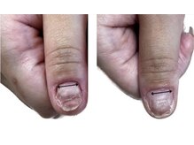 ティアラネイル 宇都宮/深爪矯正