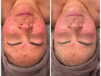 ポーデベロア(Peau des velours)/陶肌トリートメント/ビフォアフ