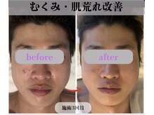 ミピマム 横浜駅前店/むくみ・肌質改善BeforeAfter