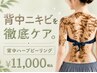 【夏のお手入れに】ニキビ・ざらつき改善｜韓国式ハーブピーリング(背中)