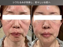 リラケア 三郷店/シワたるみを改善し若々しい肌へ