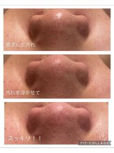 コンフィデンスサロン(Confidence Salon)/【症例】毛穴の黒ずみ