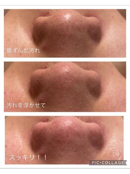 コンフィデンスサロン(Confidence Salon)/【症例】毛穴の黒ずみ