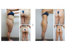 Nビューティー/最新エンダモロジーBODY