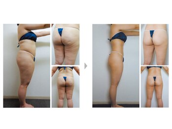 Nビューティー/最新エンダモロジーBODY