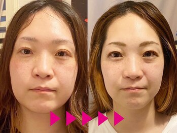 ネルジム 札幌店(NERU GYM)/8回の小顔矯正でここまで・・・