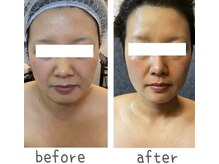 トモズサロン28(Tomos.salon.)/小顔、たるみ改善！