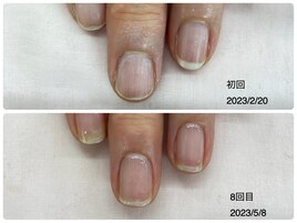 自爪育成