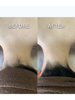 スワフルール(soi Fleur)/美人うなじ脱毛