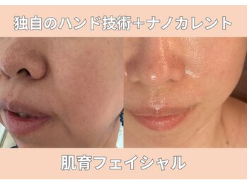 リン(Lynn)/【フェイシャル】