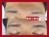 【耳毛・鼻毛・眉周りの光脱毛】抜いても生えてくるを無くす！身だしなみ脱毛
