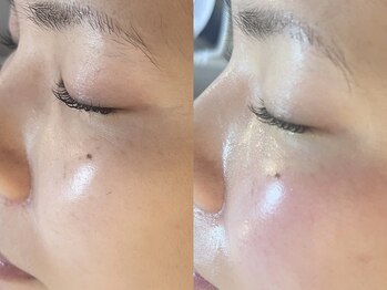 ビーマジック(Be Magic)/肌質改善!毛穴洗浄!