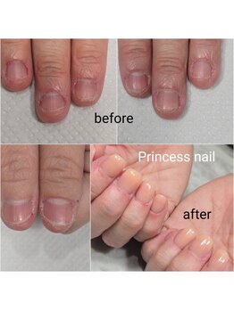 プリンセスネイル(Princess nail)/深爪矯正ベージュ