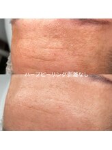 ソアン(Soin)/ハーブピーリング剥離なし